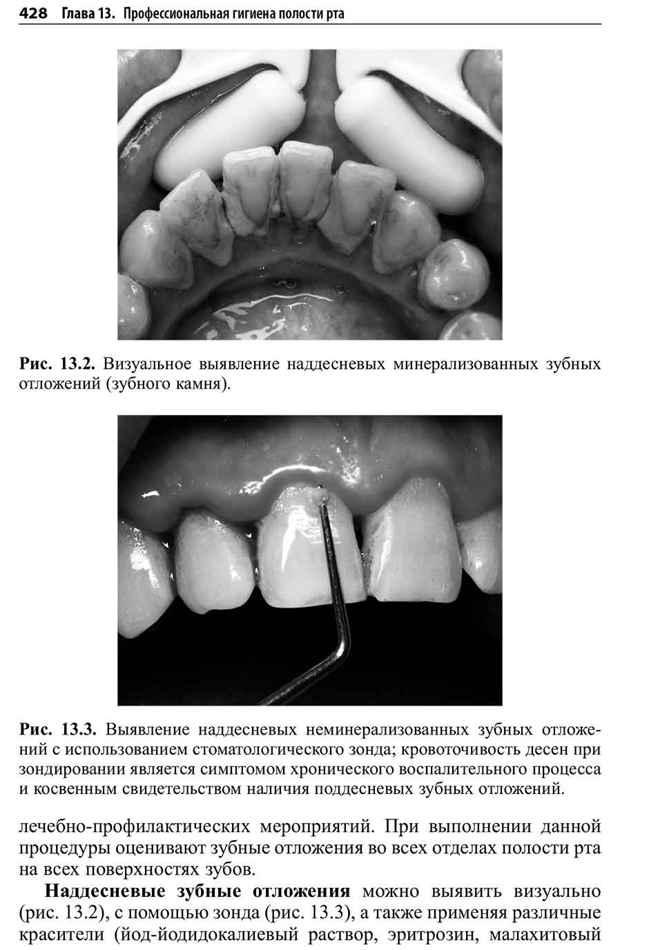 Рис. 13.3. Выявление наддесневых неминерализованных зубных отложений с использованием стоматологического зонда; кровоточивость десен 