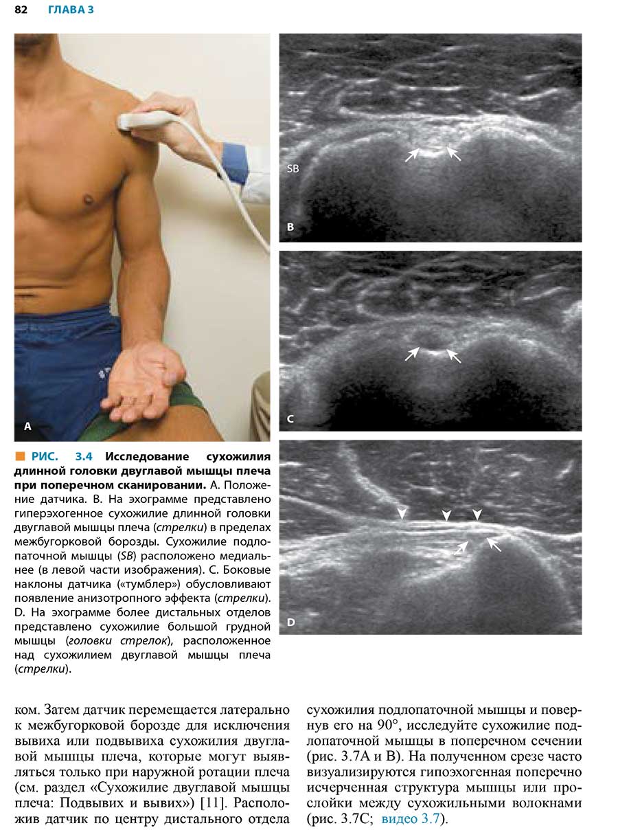  РИС. 3.4 Исследование сухожилия длинной головки двуглавой мышцы плеча