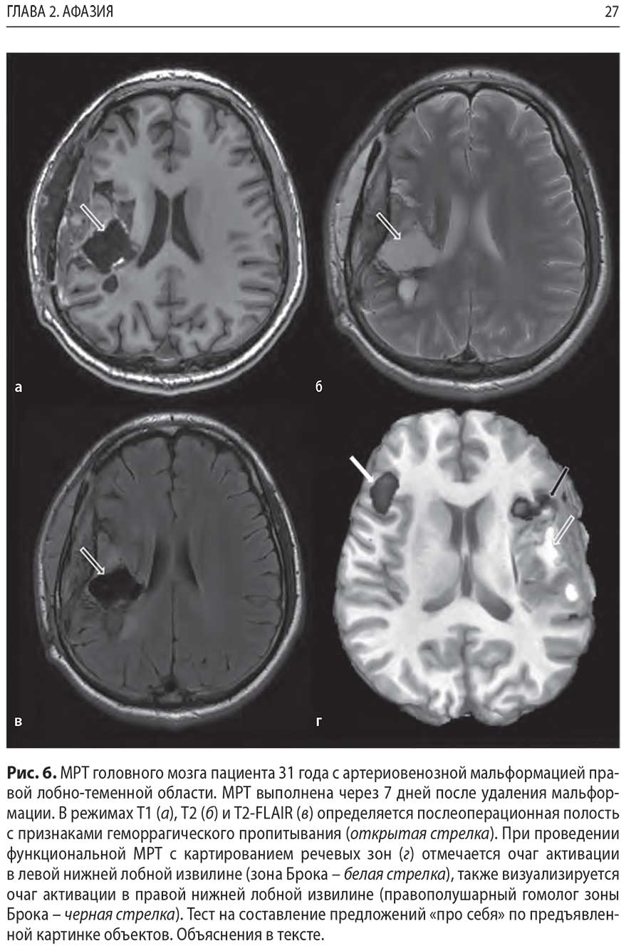 Рис. 6. MPT головного мозга пациента 31 года с артериовенозной мальформацией