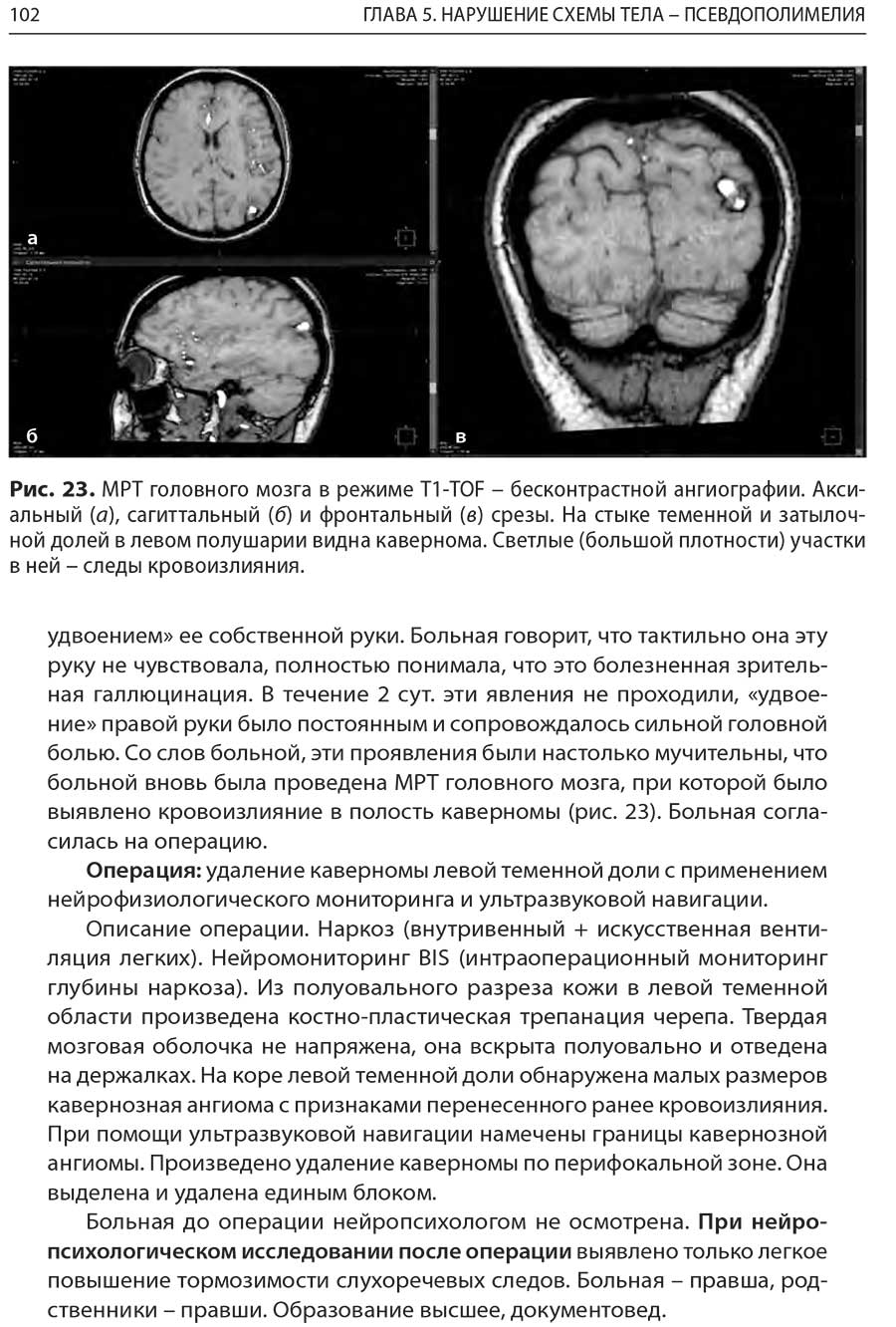 Рис. 23. MPT головного мозга в режиме T1-TOF