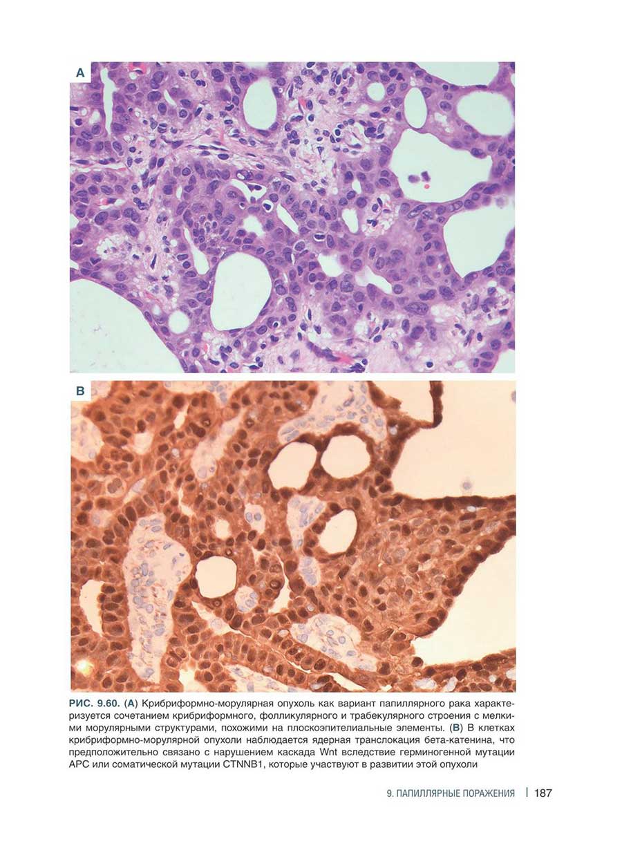 Рис. 9.60. (А) Крибриформно-морулярная опухоль как вариант папиллярного рака