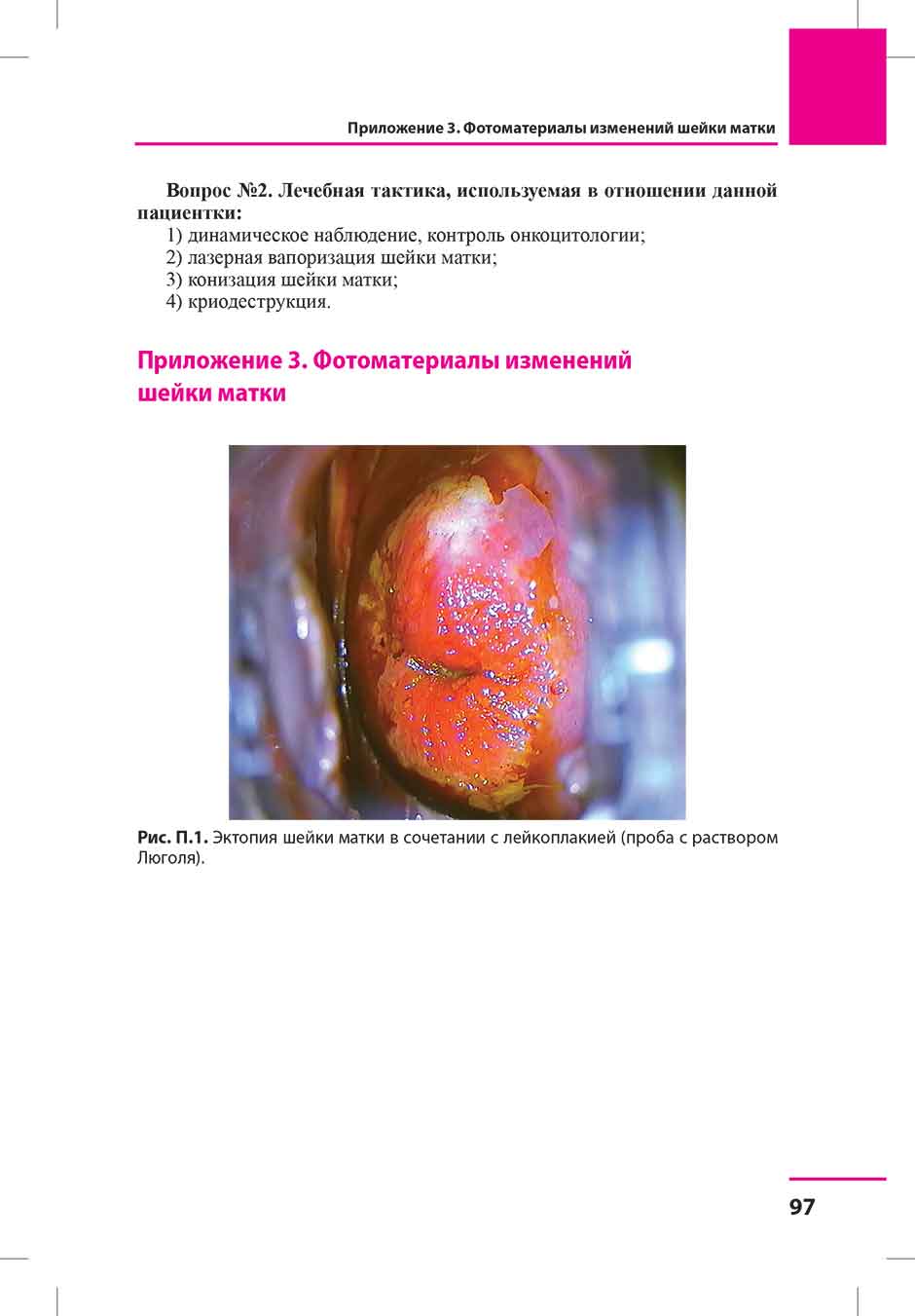 Рис. П.1. Эктопия шейки матки в сочетании с лейкоплакией (проба с раствором Люголя).