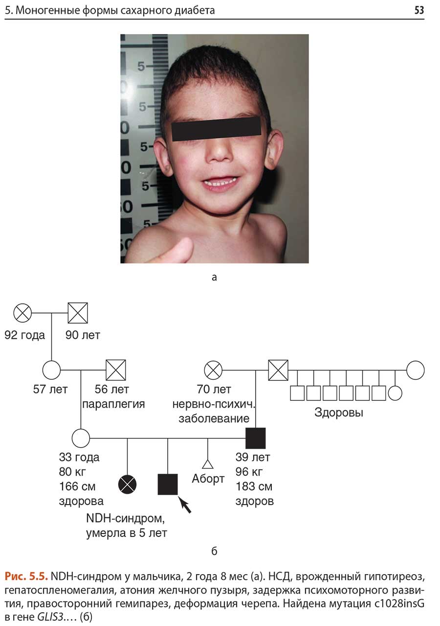 Рис. 5.5. NDH-синдром у мальчика, 2 года 8 мес (а).