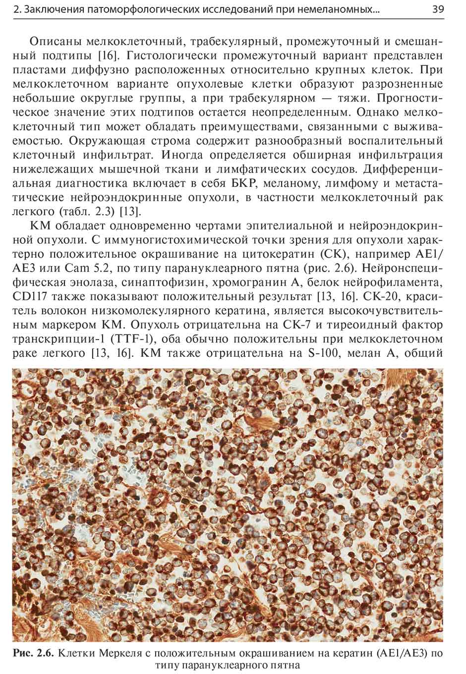 Рис. 2.6. Клетки Меркеля с положительным окрашиванием на кератин (АЕ1/АЕЗ) по типу парану клеарного пятна