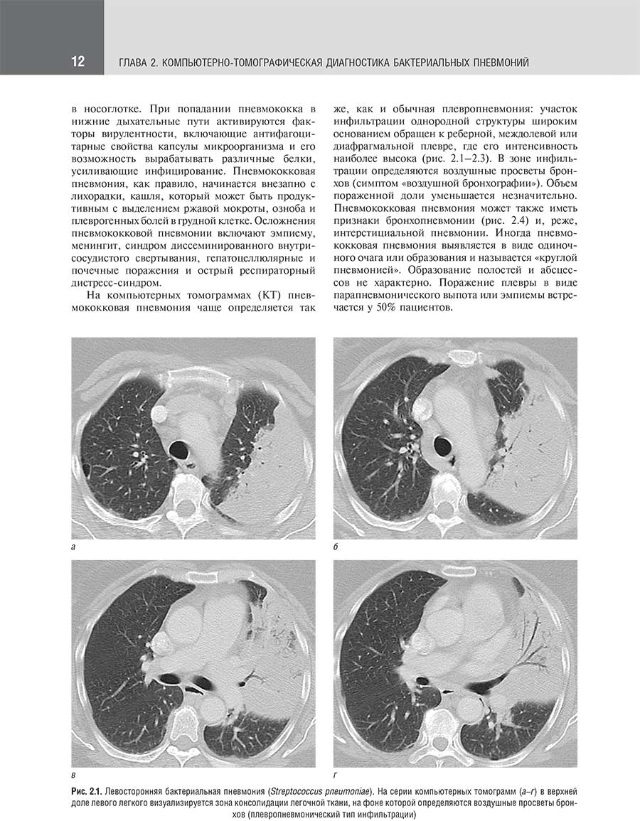 Левосторонняя бактериальная пневмония