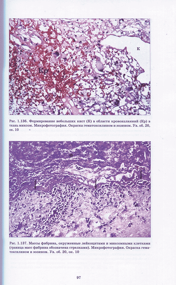 Массы фибрина, окруженные лейкоцитами