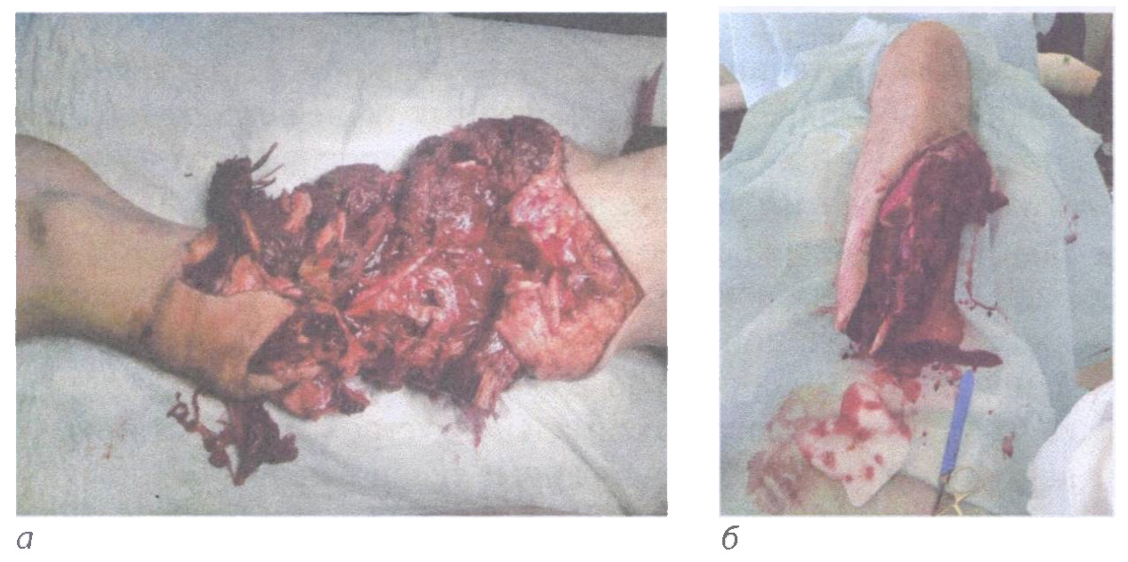 Ранение крупнокалиберной пулей: а — разрушение голени; б — выполнена ампутация голени по типу первичной хирургической обработки по поводу разрушения голени