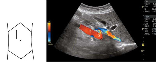 Рис. 1.18. Продольное косое сканирование аорты с визуализацией устьев почечных артерий