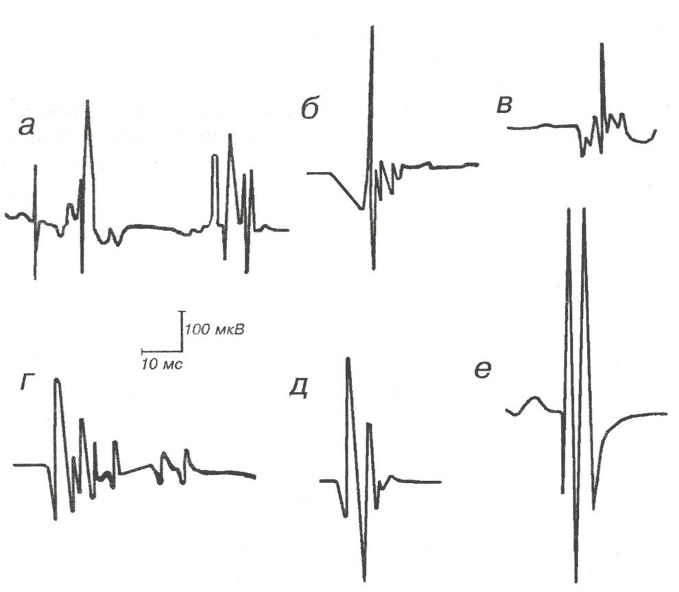 Полифазные ПДЕ, регистрируемые при миопатиях Полифазные ПДЕ, регистрируемые при миопатиях