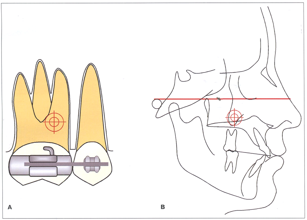 Рис. 1 -2 Центр сопротивления группы из двух зубов (А) и верхней челюсти (В).