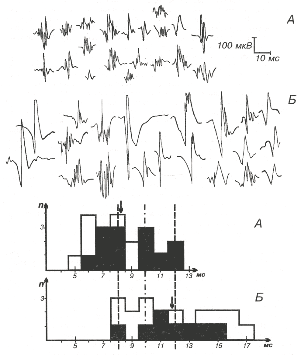 Потенциалы различных ДЕ, зарегистрированные в дельтовидной мышце больного 22 лет с полимиозитом Потенциалы различных ДЕ, зарегистрированные в дельтовидной мышце больного 22 лет с полимиозитом