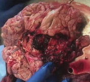 Ишемический инфаркт головного мозга с вторичным геморрагическим пропитыванием