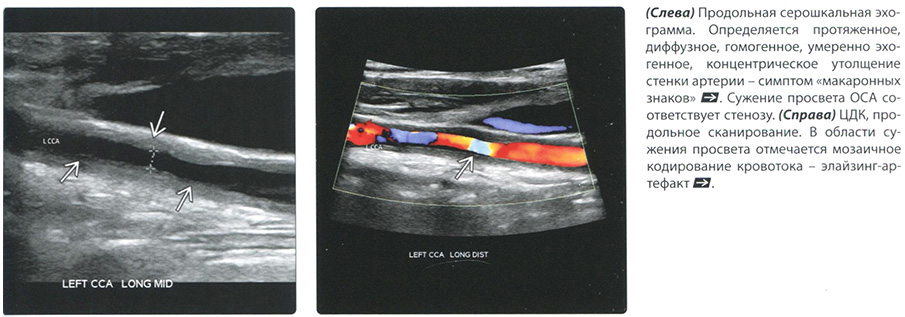 Болезнь Такаясу. УЗИ диагностика