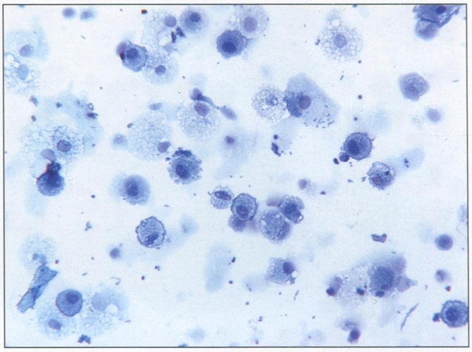 Индуцированный секрет здорового добровольца. В мазке преобладают альвеолярные макрофаги. Окраска азур-эозином.