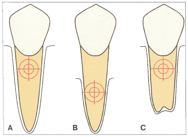 Рис. 1-3 Локализация центра сопротивления зуба зависит от количества костной ткани и длины корня