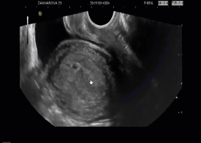 Видеопример: беременность 4-5 недель