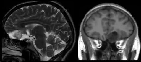 Пациент, А., 52 г., аносмия МРТ. Невринома обонятельного нерва