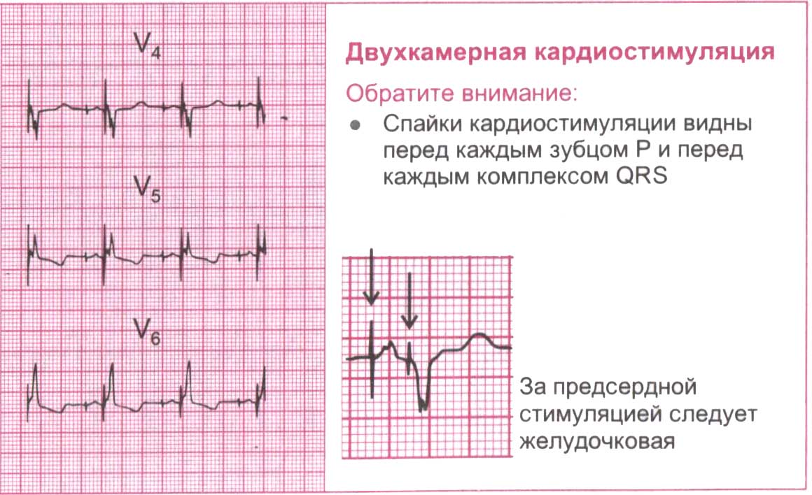 Двухкамерная кардиостимуляция