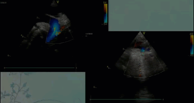 Спектр врожденных пороков сердца у новорожденных с ВДГ. Обструктивные заболевания порты