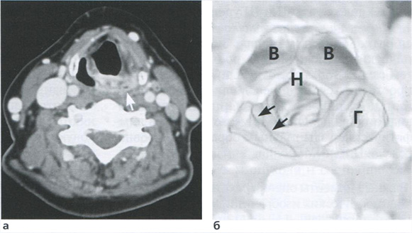  Рак гортаноглотки. При КТ с контрастированием выявляется спавшийся груше­ видный синус