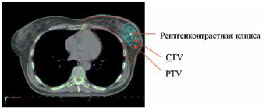 Рис. 2. Пример оконтуривания лечебных объёмов (СTV и PTV) для подведения дополнительной дозы на ложе опухоли