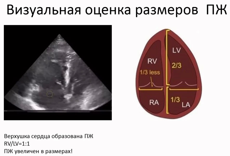 Визуальная оценка размеров правого желудочка (ПЖ) сердца