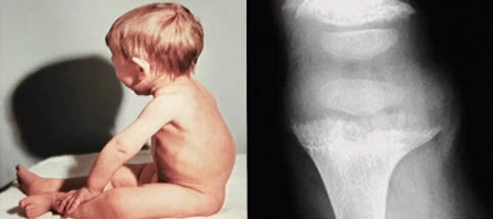 Развитие костных признаков рахита у детей раннего возраста обусловлено
