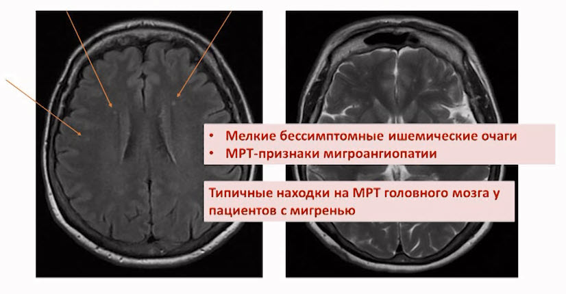 МРТ пациента 62-х лет с жалобами на головную боль головокружение