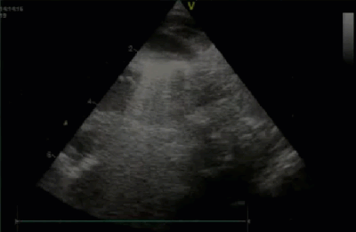 Спектр врожденных пороков сердца у новорожденных с ВДГ. Обструктивные заболевания аорты