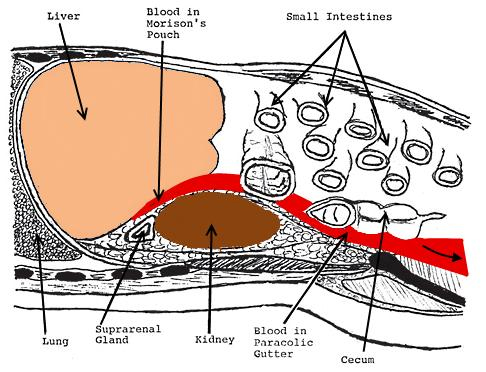 Продольное изображение скопления жидкости в кармане Морисона (между печенью и правой почкой)