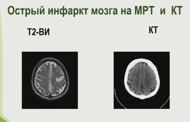 Острый инфаркт мозга на МРТ и КТ