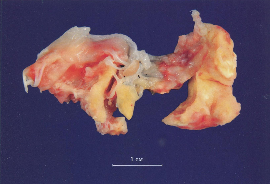 Тромботические массы, в которых замурованы хорды и часть створок митрального клапана. Макрофотография