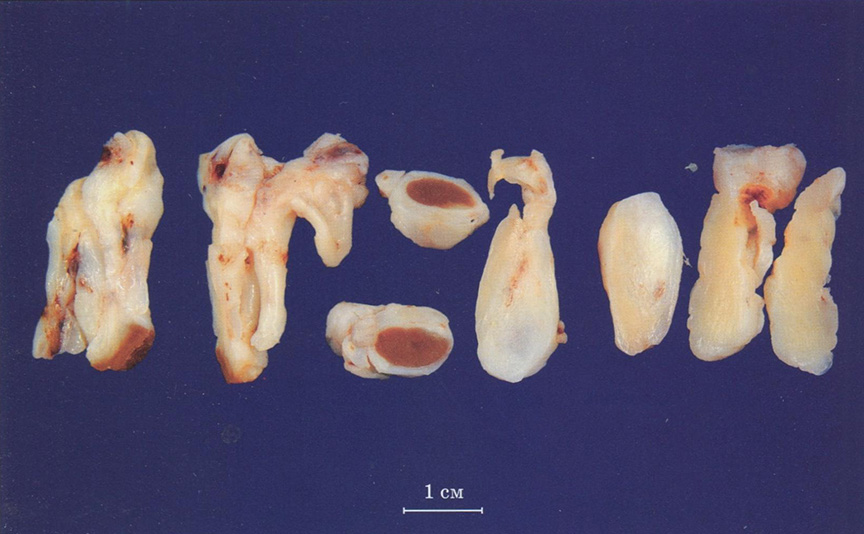  Фиброзная, гиалинизированная ткань в эндокарде выводного отдела левого желудочка, замуровывающая трабекулы миокарда