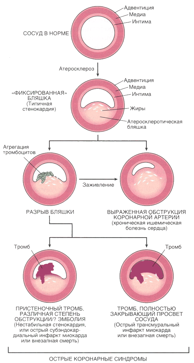 Схема последовательного прогрессивного поражения коронарных артерий
