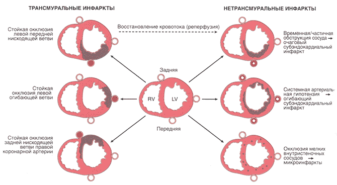 Инфаркт миокарда в зависимости от локализации и степени выраженности недостаточности кровоснабжения