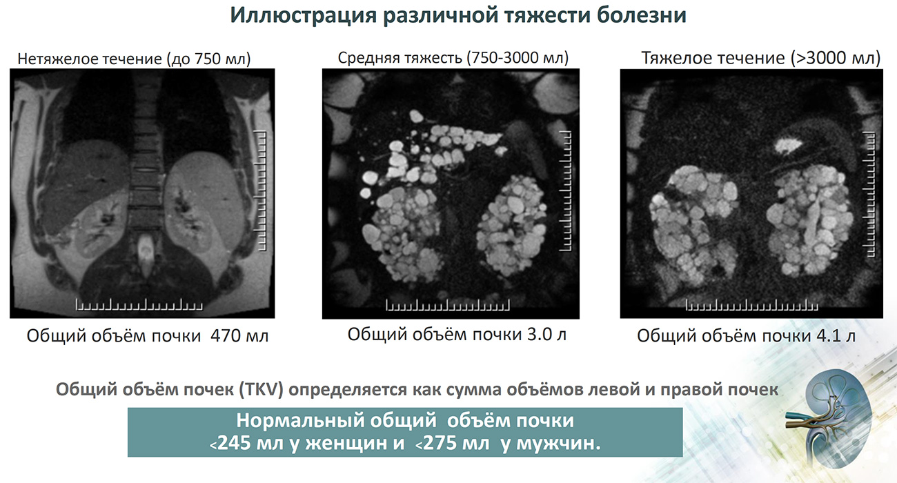 Иллюстрация различной тяжести болезни АДПКБП