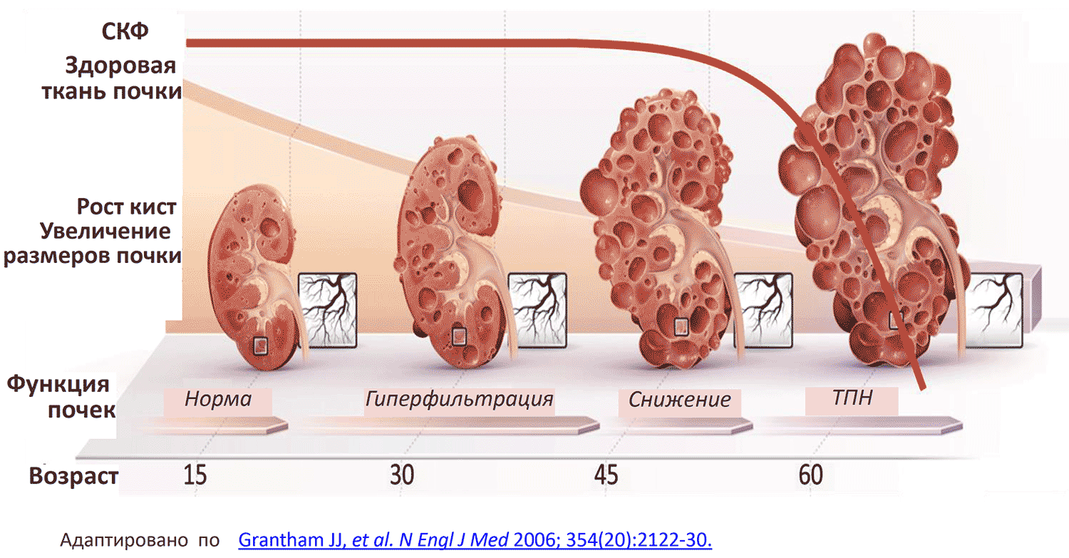 Рост кист. Увеличение размеров почки