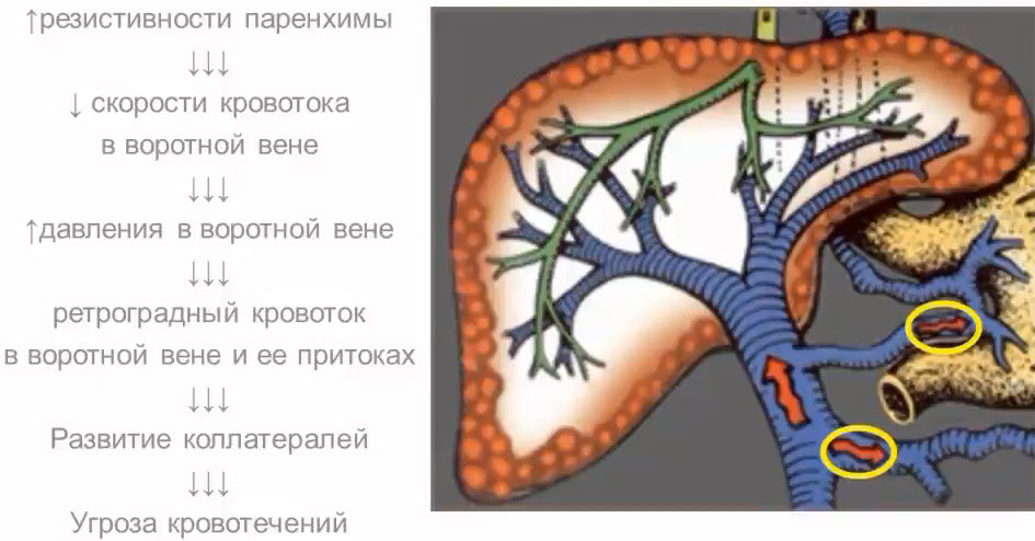 Портальная гипертензия (патогенез и этапы развития)
