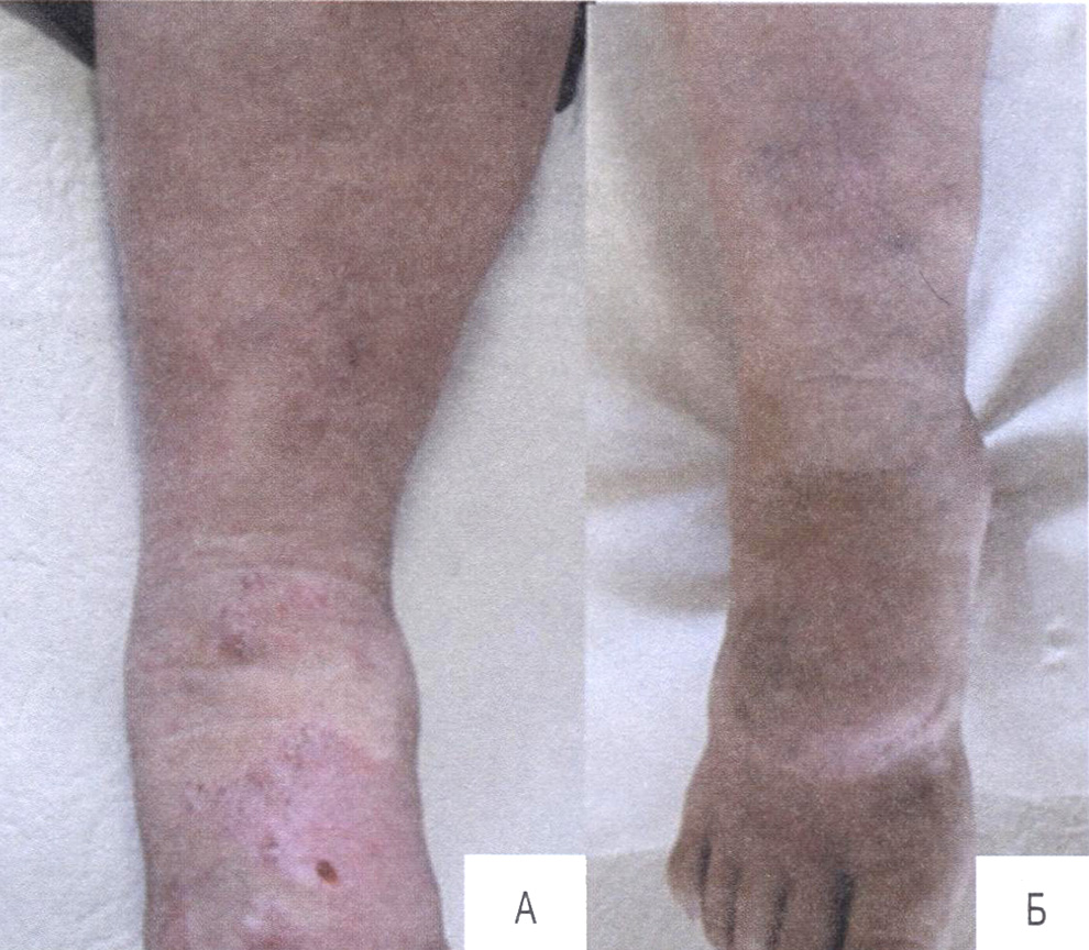 Рис. 38. Гипертрофический рубец до (А) и после использования инвазивной карбокситерапии (Б)
