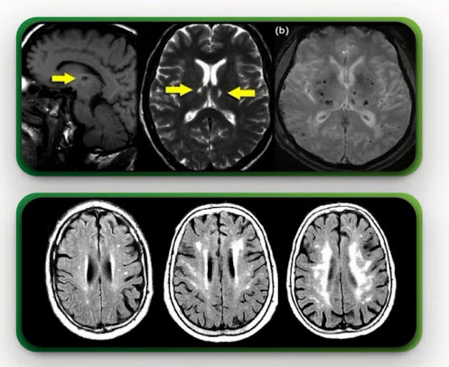 Нейрорадиологическая картина при церебральной микроангиопатии