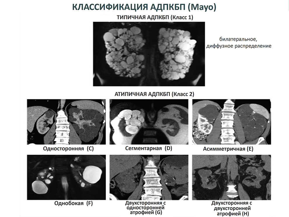 Классификация АДПКБП (Mayo)