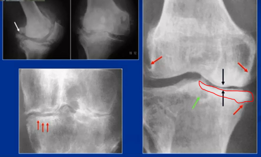 Рентгенодиагностика остеоартроза