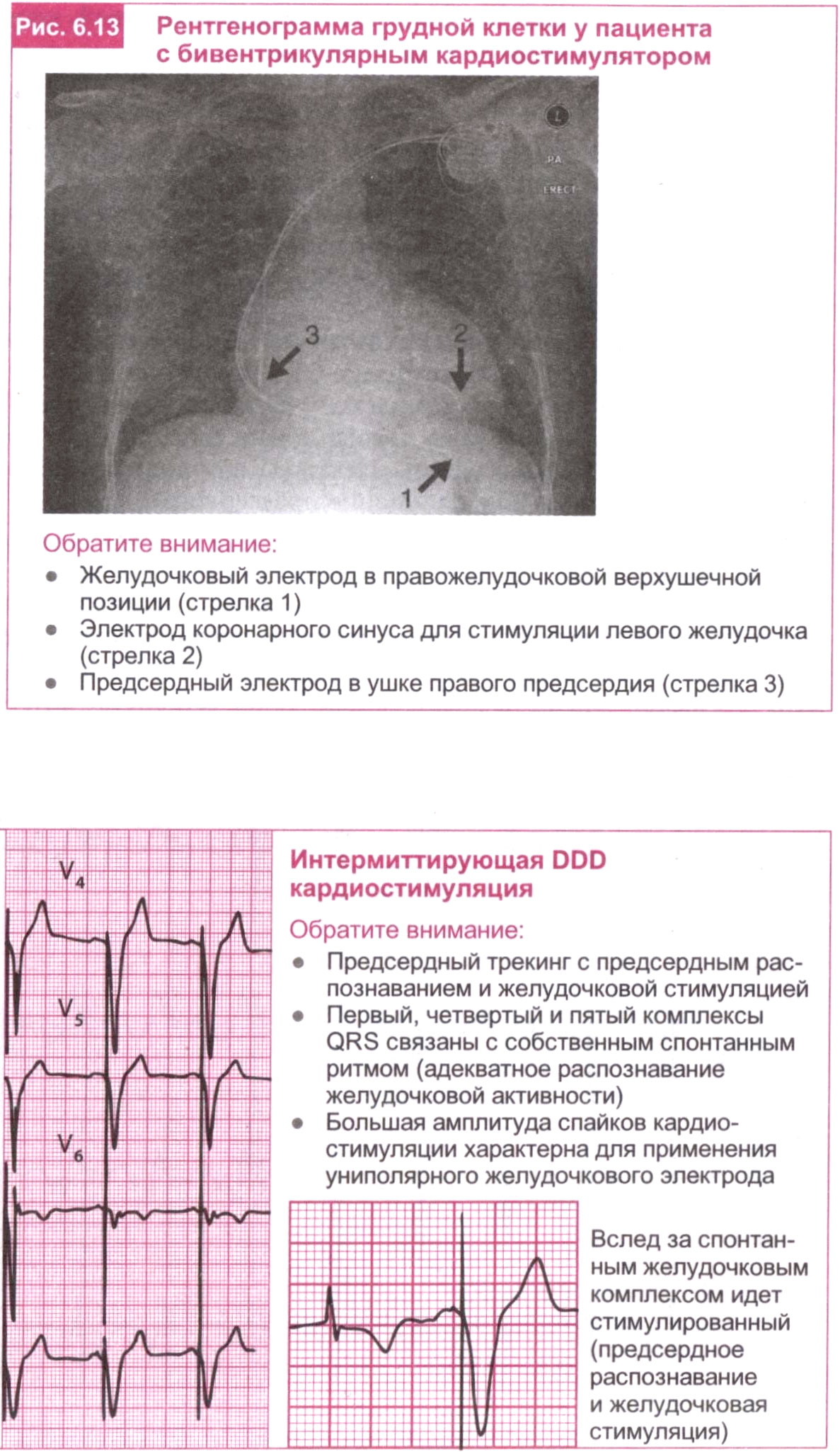 Рентгенограмма грудной клетки у пациента с бивентрикулярным кардиостимулятором