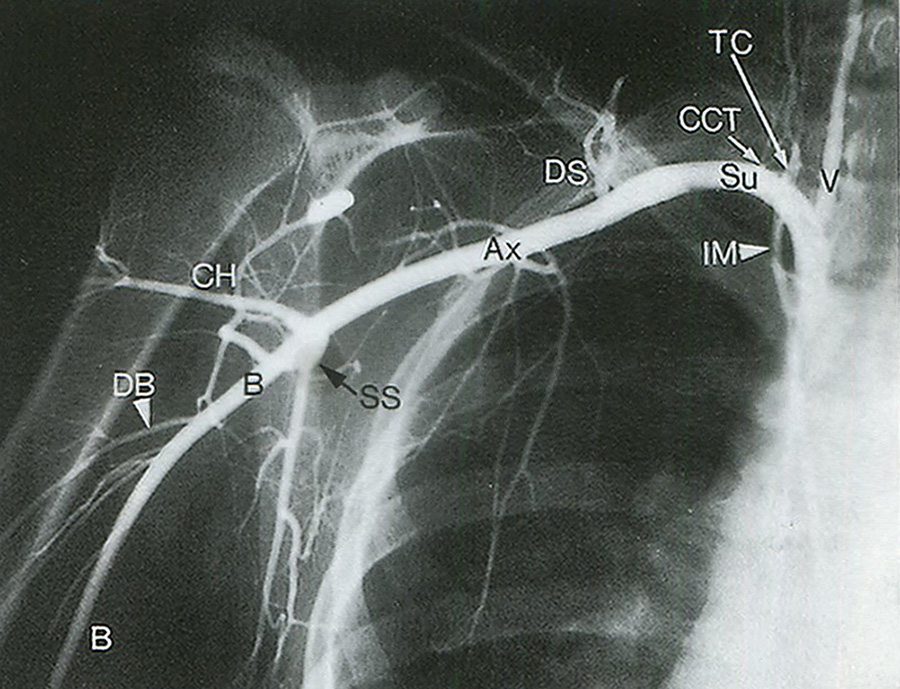 Рис. 14.3. Подключичная артерия (Su) отходит от подмышечной артерии (Ах)