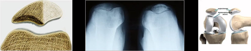 Основной клинический признак хондромаляции - хруст в коленном суставе