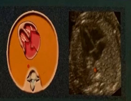 Располагается ли нисходящая аорта слева от позвоночника и нет ли изображения расширенной непарной вены справа от нисходящей аорты?