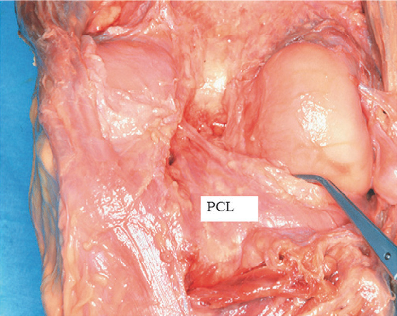 Анатомический препарат коленного сустава: показана задняя крестообразная связка с дорсальной стороны 