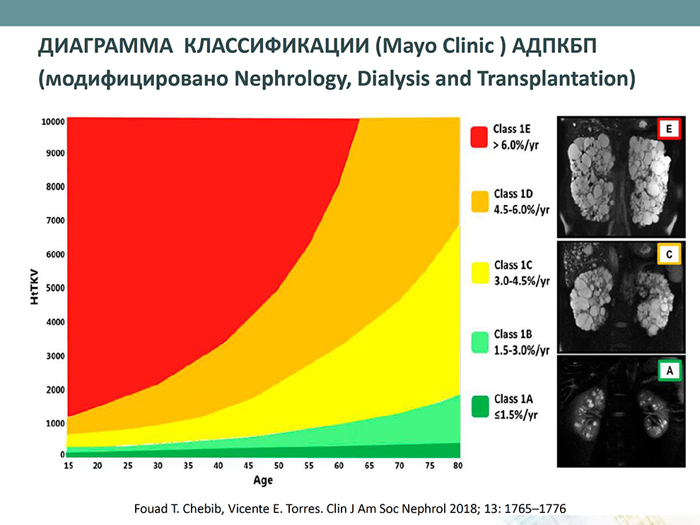 Диаграмма классификации (Mayo Clinic ) АДПКБП (модифицировано Nephrology, Dialysis and Transplantation)