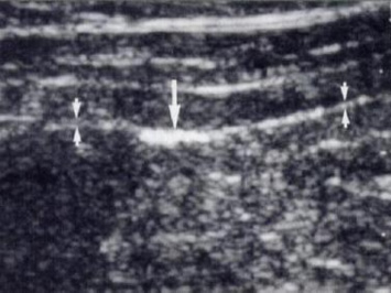 Нормальная перитонеальная полоска (маленькие стрелки) в виде тонкой эхогенной линии на границе между передней абдоминальной стенкой
