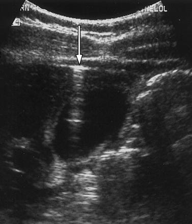 На продольном изображении правого верхнего квадранта, полученном при повороте пациента на левый бок